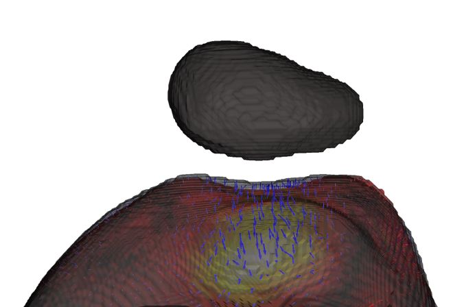 3D Pseudo-Healthy Knee MRI